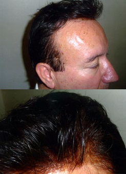 New generation hair replacement. – John Lester